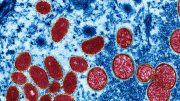 VIRUELA del MONO llega a 1586 CASOS en Florida según Dpto de Salud