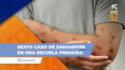 SEXTO caso de SARAMPIÓN en una escuela primaria de Broward